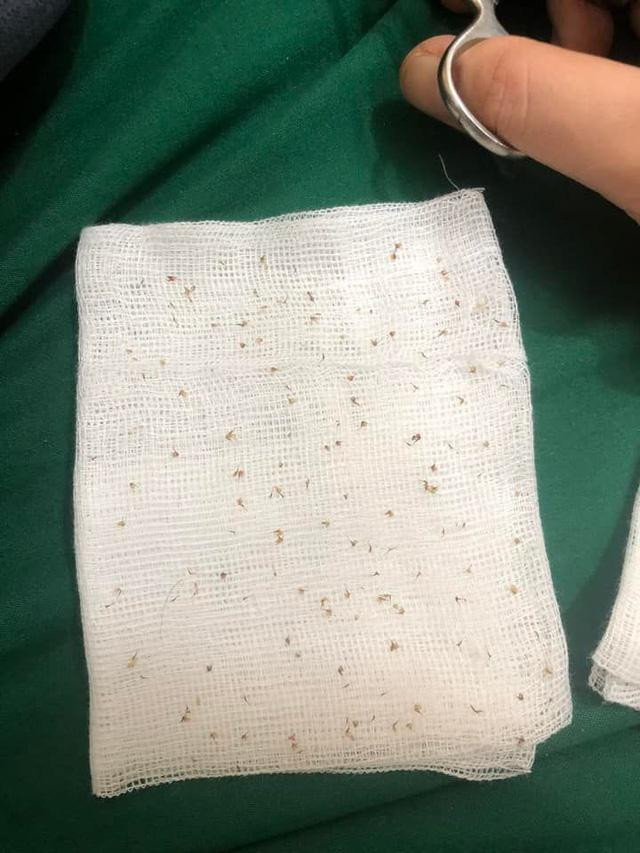 Nọc ong được lấy ra khỏi cơ thể bệnh nhân. Ảnh: BV.