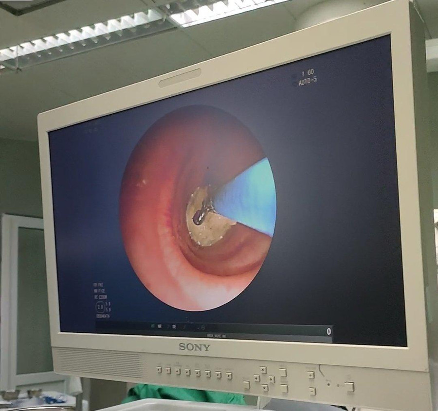 Hình ảnh dị vật gây bít tắc lòng phế quản của bệnh nhân. Ảnh: BV.