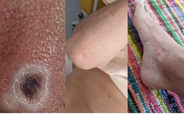 Triệu chứng thường gặp là các vết tổn thương da. Ảnh: The Telegraph.