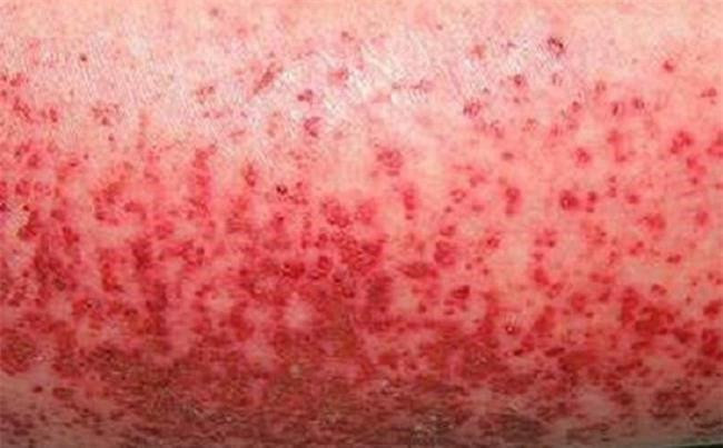 Phát ban là một trong các triệu chứng sốt xuất huyết ở người lớn. Ảnh minh họa. Phát ban là một trong các triệu chứng sốt xuất huyết ở người lớn. Ảnh minh họa.