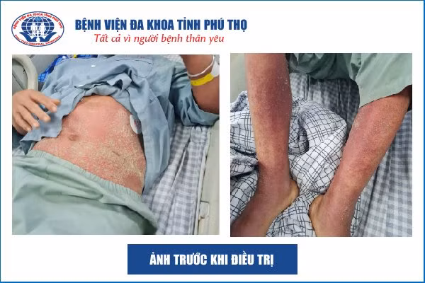 5 khuyến cáo của Bộ Y tế phòng nhiễm khuẩn huyết do liên cầu lợn ảnh 1