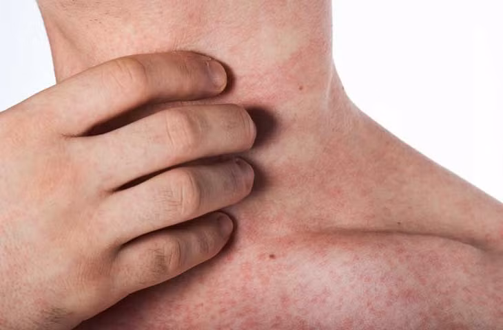 Phát ban ở người bệnh sốt xuất huyết. Nguồn: BV Hồng Ngọc.