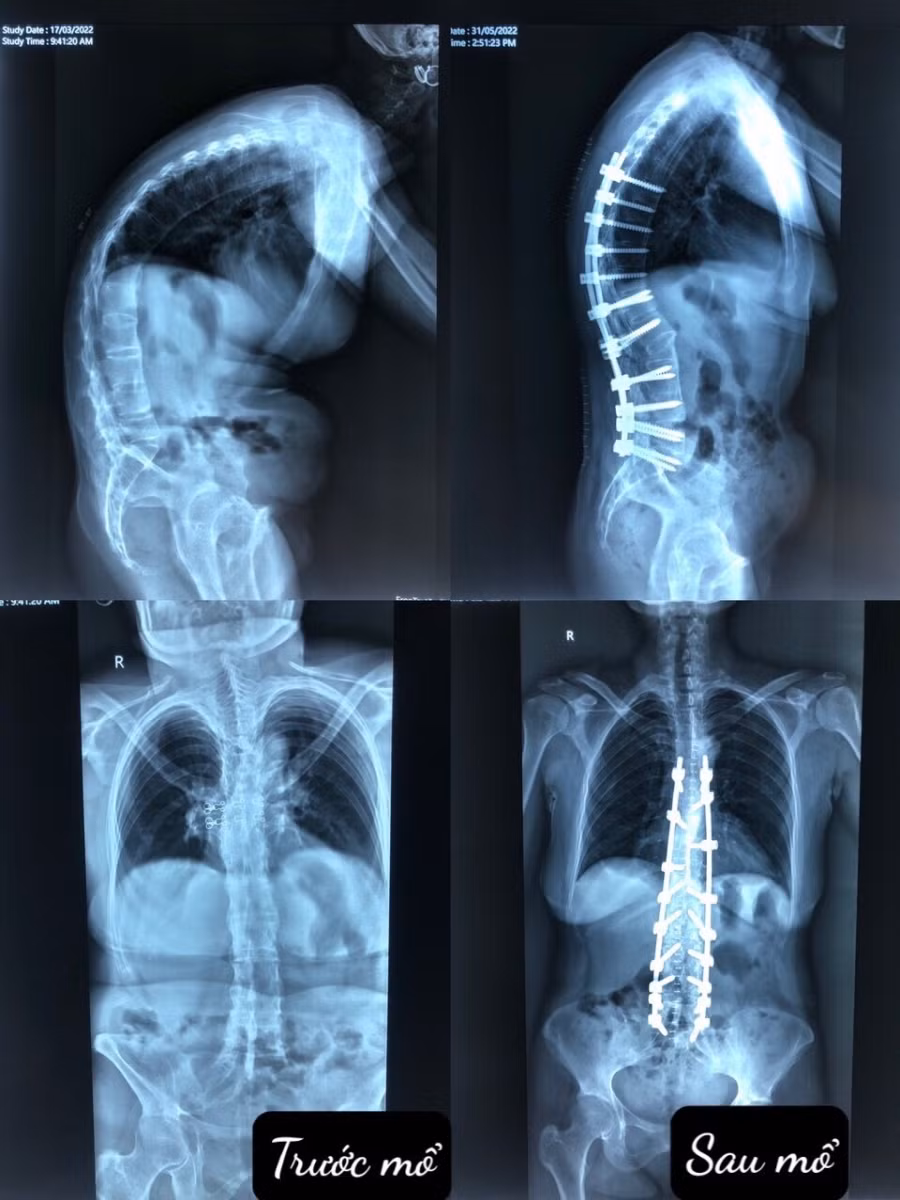 5 tiếng cân não phẫu thuật nắn chỉnh gù cho bệnh nhân nhiễm HIV ảnh 2