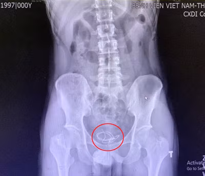 Đoạn dây tai nghe trong bàng quang của người bệnh trên phim chụp X.Quang. Ảnh: BV.