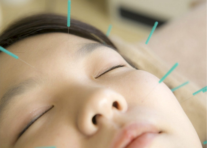 Điều trị liệt dây thần kinh số 7 bằng phương pháp châm cứu. Ảnh: ITN Điều trị liệt dây thần kinh số 7 bằng phương pháp châm cứu. Ảnh: ITN