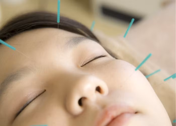 Điều trị liệt dây thần kinh số 7 bằng phương pháp châm cứu. Ảnh: ITN