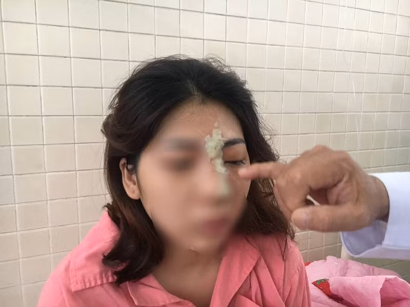 Mắt chị T. chưa thể mở được bình thường. Ảnh: HL.