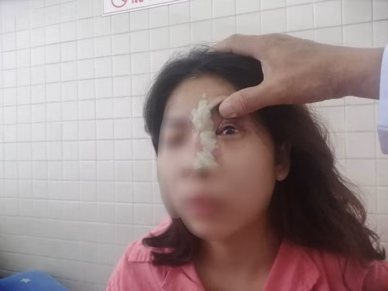 Cô gái 21 tuổi mù mắt sau khi tiêm filler nâng mũi - ảnh 2
