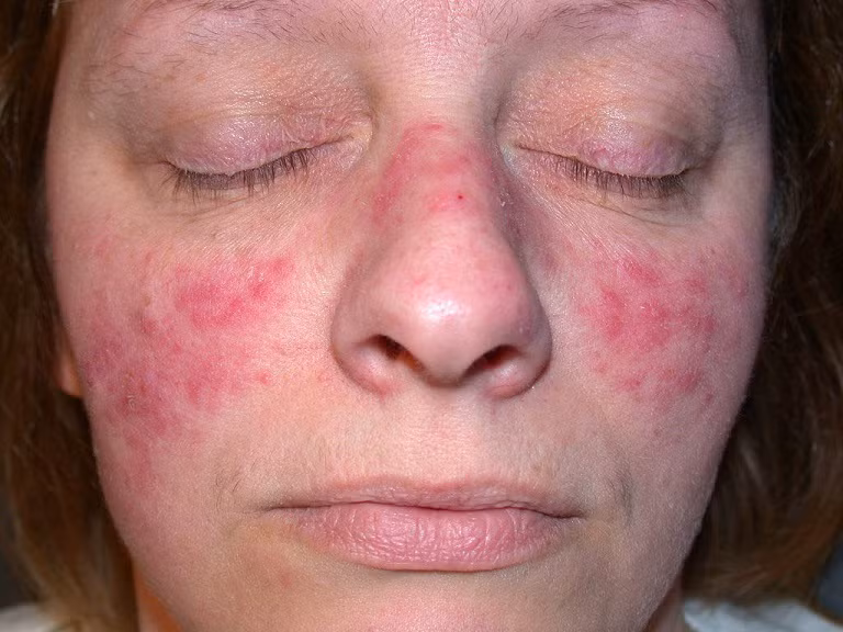 Lupus ban đỏ dạng đĩa với triệu chứng ban đỏ hình cánh bướm trên da mặt. Ảnh minh họa. Lupus ban đỏ dạng đĩa với triệu chứng ban đỏ hình cánh bướm trên da mặt. Ảnh minh họa.