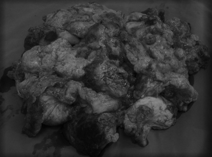 Khối u sau khi loại bỏ hoàn toàn nặng 3kg Khối u sau khi loại bỏ hoàn toàn nặng 3kg