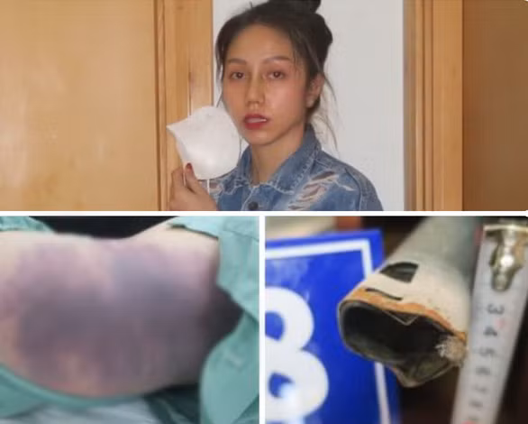 Bị can Nguyễn Võ Quỳnh Trang và các dấu tích của vụ bạo hành. Ảnh: CACC.