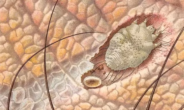 Bọ ve Sarcoptei scabieis gây bệnh ghẻ ở cơ quan sinh dục nam.