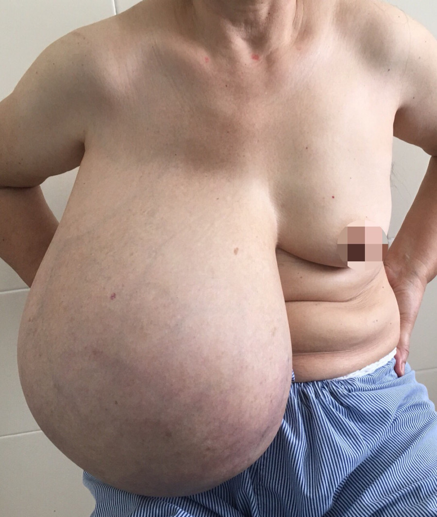 Khối u mà bệnh nhân “sống chung” hơn 10 năm