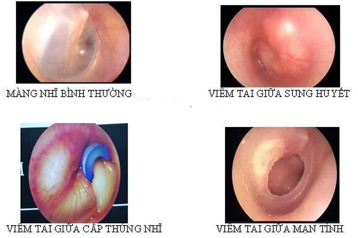 Lưu ý đặc biệt khi dùng thuốc trị viêm tai giữa cấp ở trẻ