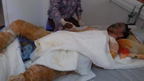 Nan nhan bi bong nang do chay xang da tu vong - Anh 1