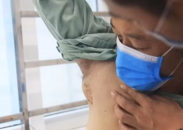 Mắc bệnh sau khi bị mèo cào