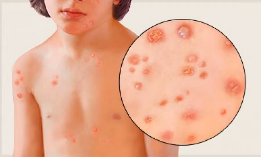 Sau thời gian ủ bệnh, trên cơ thể người bị thủy đậu sẽ bắt đầu phát ban dạng mụn nước. Ảnh minh họa