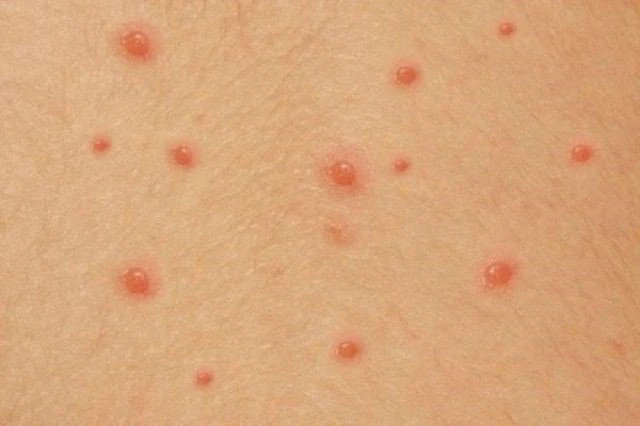 Thủy đậu là bệnh nhiễm trùng do virus varicella-zoster gây ra. Ảnh minh họa