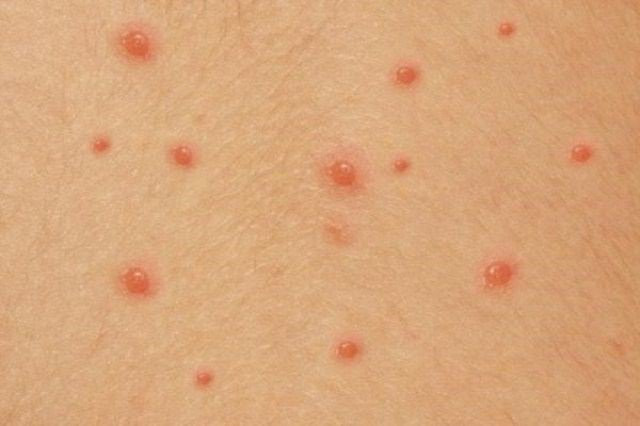 Thủy đậu là bệnh nhiễm trùng do virus varicella-zoster gây ra. Ảnh minh họa