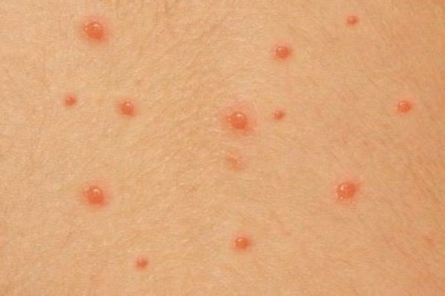 Thủy đậu là bệnh nhiễm trùng do virus varicella-zoster gây ra. Ảnh minh họa
