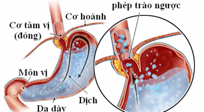 Cách phòng bệnh trào ngược dạ dày - thực quản