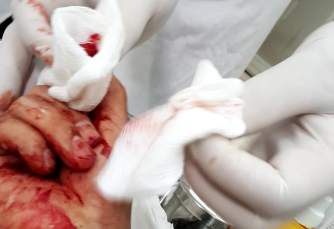 Ngoài việc bị đánh bầm dập ở tay, anh Hoàng còn bị nhiều chỗ khác