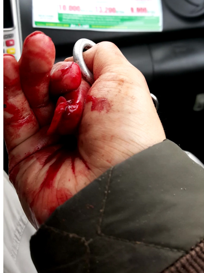 Ngoài việc bị đánh bầm dập ở tay, anh Hoàng còn bị nhiều chỗ khác nữa.