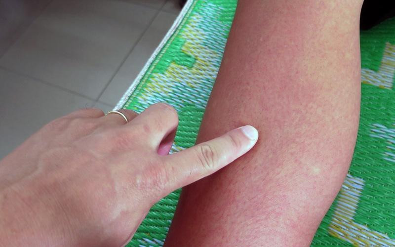 Bệnh nhân sốt xuất huyết phát ban đỏ.