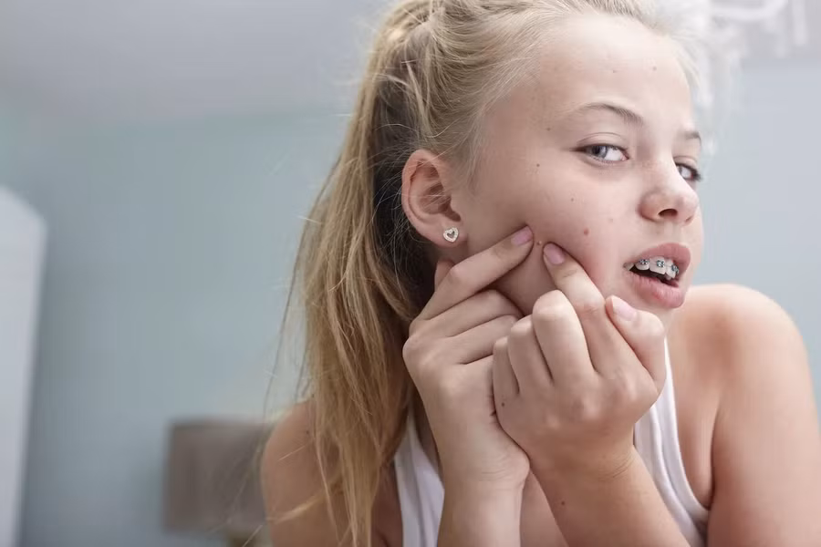 Không phải thanh thiếu niên nào cũng nhớ để dùng sản phẩm trị mụn thường xuyên. Ảnh minh họa: ITN