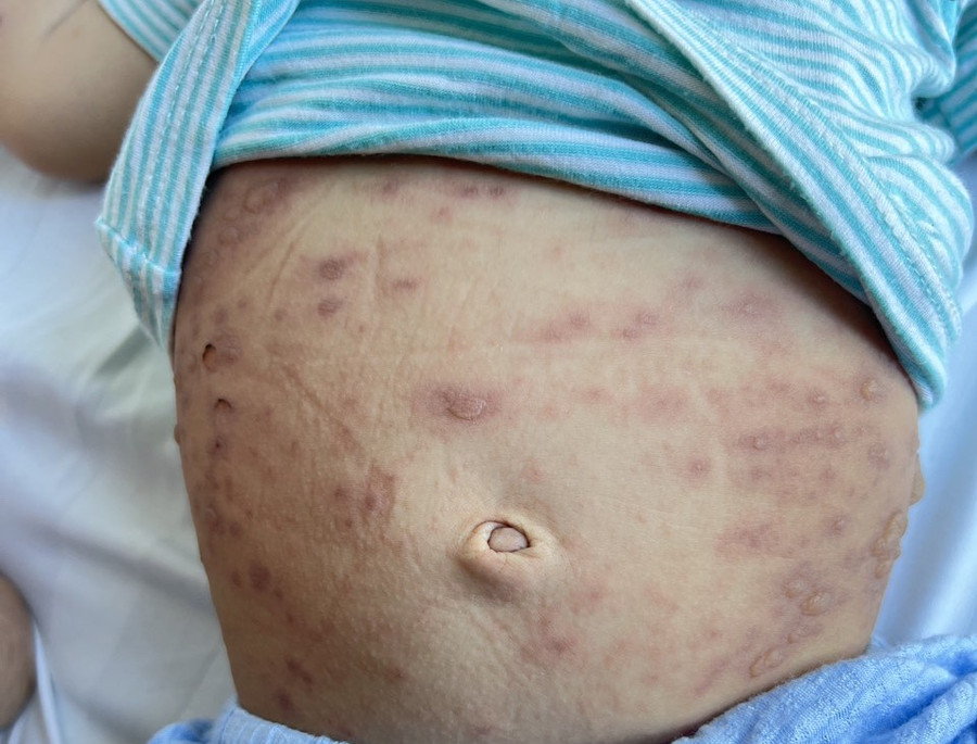 Trẻ mắc hội chứng Steven-Johnson được điều trị tại Bệnh viện Đa khoa Tâm Anh TPHCM. Ảnh: BVCC Trẻ mắc hội chứng Steven-Johnson được điều trị tại Bệnh viện Đa khoa Tâm Anh TPHCM. Ảnh: BVCC