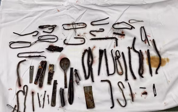 Dị vật nhiều loại kim loại được lấy ra trong dạ dày bệnh nhân. Ảnh: BV Quân y 175.