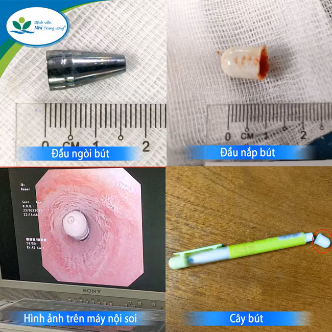 Hình ảnh đầu ngòi bút và đầu nắp bút được gắp ra từ khí quản 2 bệnh nhi. Ảnh: BVCC.