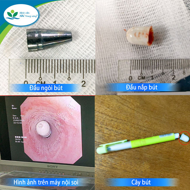 Hình ảnh đầu ngòi bút và đầu nắp bút được gắp ra từ khí quản 2 bệnh nhi. Ảnh: BVCC. Hình ảnh đầu ngòi bút và đầu nắp bút được gắp ra từ khí quản 2 bệnh nhi. Ảnh: BVCC.