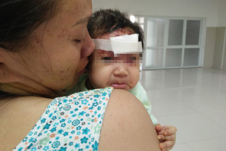 Bé gái 2 tháng tuổi bị khỉ cào rách mặt - Ảnh 1 Be gai 2 thang tuoi bi khi cao rach mat - Anh 1