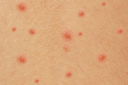 Người bị bệnh thủy đậu có thể mọc khoảng 100 - 500 nốt. Ảnh minh họa.