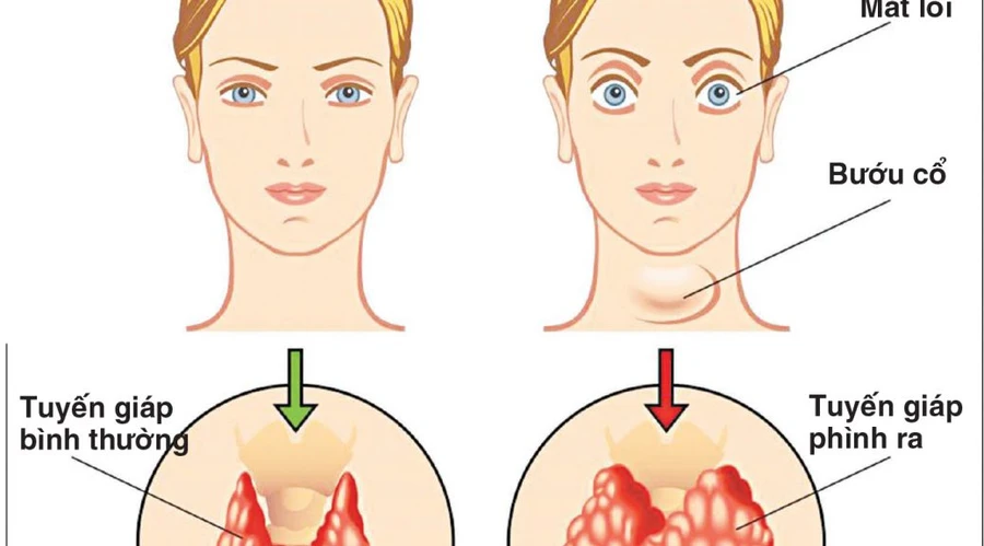 Bướu cổ là một khối u do tuyến giáp phình to tạo thành. Ảnh: IT