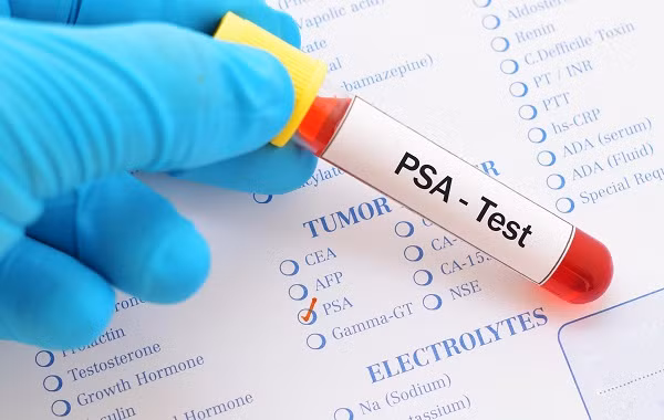 Người bệnh cần được thăm khám tầm soát tiền liệt tuyến, bao gồm khám bằng tay và đo chất PSA. Ảnh minh họa.