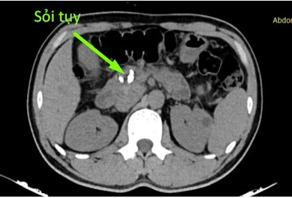 Sỏi tụy ở bệnh nhân. (Ảnh: BVCC)
