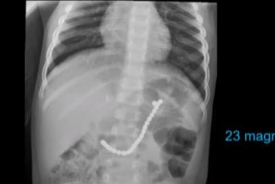 Hình ảnh X quang của Caiden. Hình ảnh X quang của Caiden.