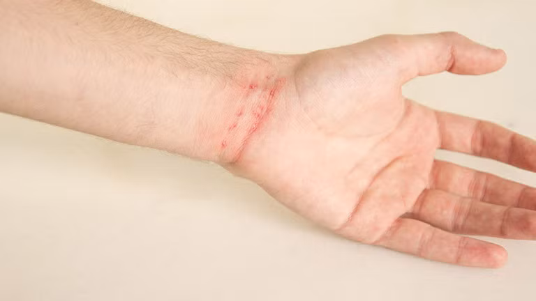 Bệnh ghẻ gây khó chịu cho người bệnh vì bị ngứa.