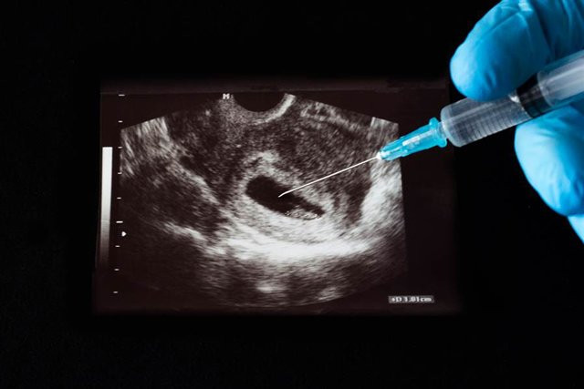 Sau 7 lần phá thai, bác sĩ thông báo Xiao Fei không còn cơ hội mang thai nữa (Ảnh minh họa).