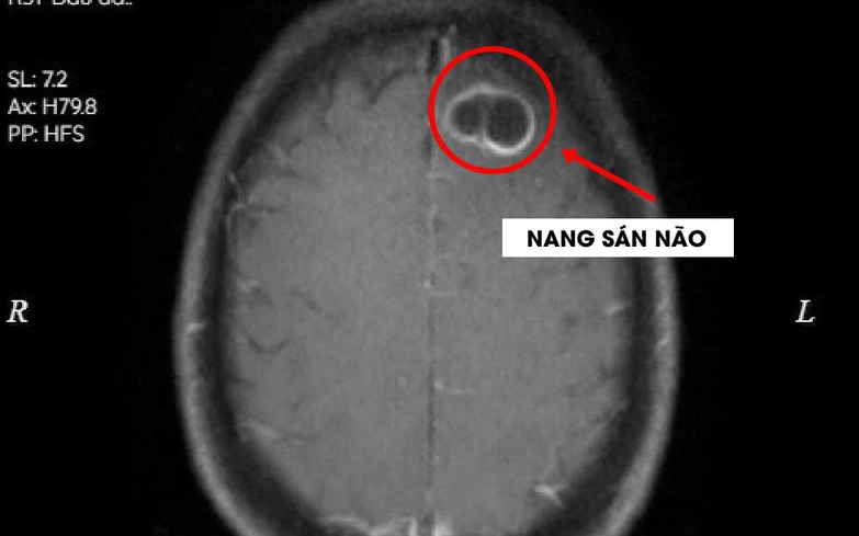 Bệnh nhân phát hiện có nang sán trong não và đều có thói quen ăn tiết canh Bệnh nhân phát hiện có nang sán trong não và đều có thói quen ăn tiết canh