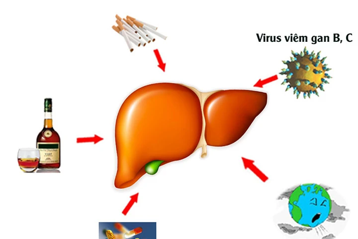 Những giải pháp bảo vệ gan hiệu quả bạn nên làm theo