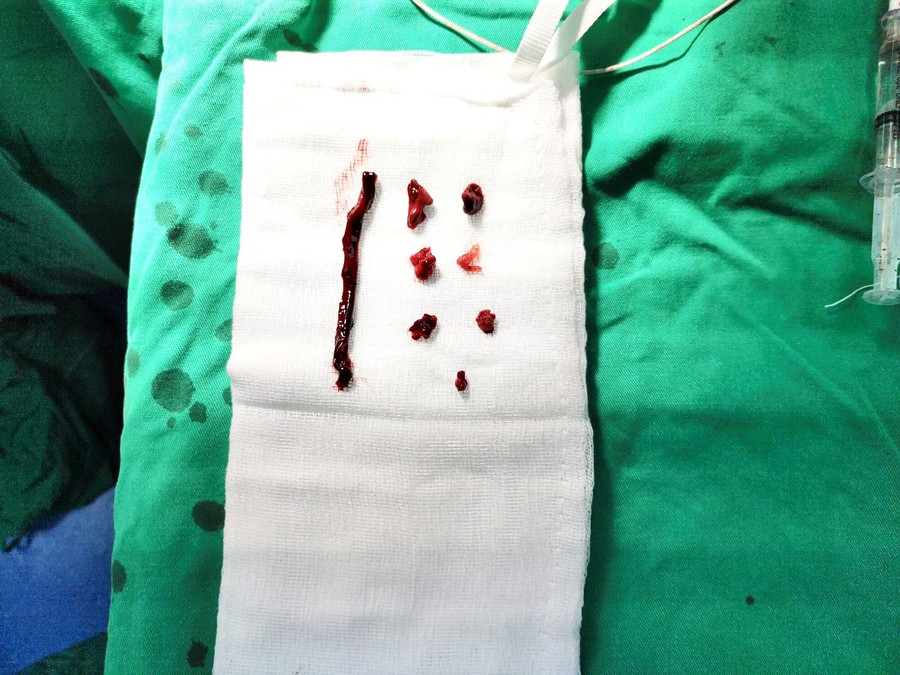 Hình ảnh huyết khối được phẫu thuật. Ảnh: BVCC. Hình ảnh huyết khối được phẫu thuật. Ảnh: BVCC.