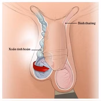 Căn bệnh khiến bé trai 11 tuổi mất tinh hoàn