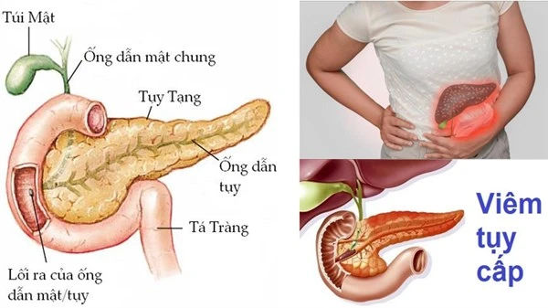 Biểu hiện của bệnh viêm tụy cấp.