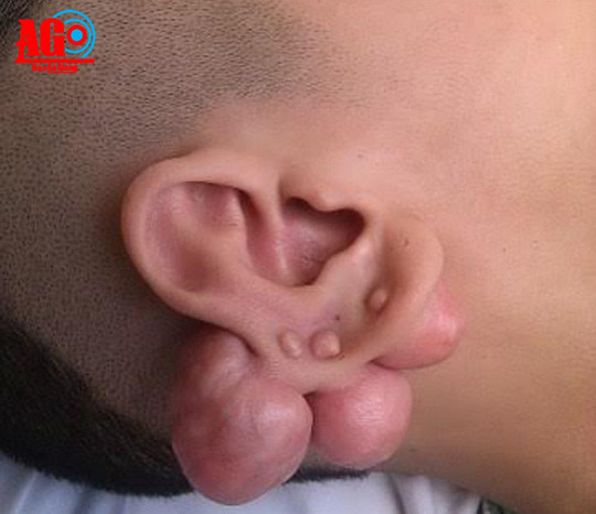 Xỏ nhiều lỗ tai, thanh niên 17 tuổi bị khối u to, biến dạng tai ảnh 1 Biến chứng do xỏ nhiều lỗ tai