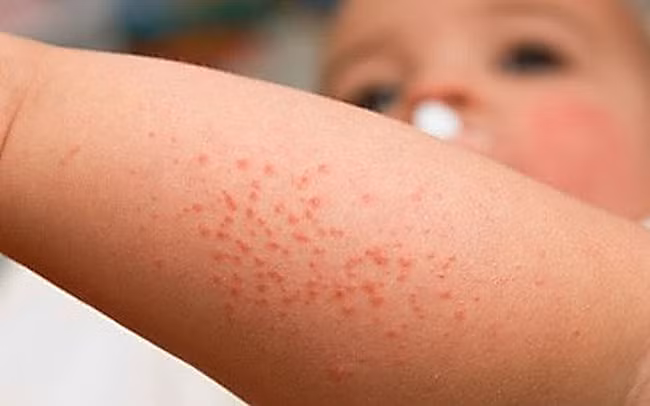 Một số bệnh dịch khác vẫn còn (Covid-19, cúm, thủy đậu…) nên dễ chẩn đoán nhầm với sốt xuất huyết. (Ảnh minh họa)