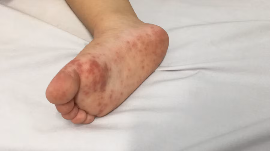 Ở một số trường hợp, trẻ bị tay chân miệng có thể chuyển nặng trong 48 giờ. Ảnh minh họa