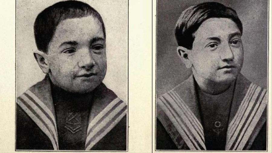 Bức ảnh của một cậu bé 14 tuổi trước và sau một năm được ghép tuyến giáp của khỉ.